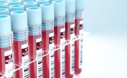 Anemia